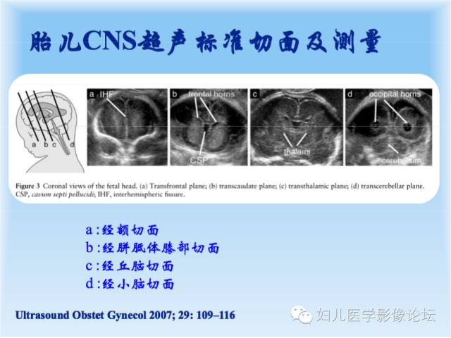 【PPT】胎儿颅脑常见先天异常MRI诊断