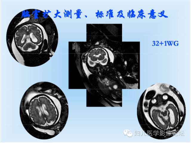 【PPT】胎儿颅脑常见先天异常MRI诊断