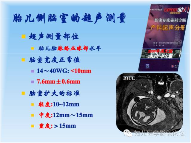 【PPT】胎儿颅脑常见先天异常MRI诊断