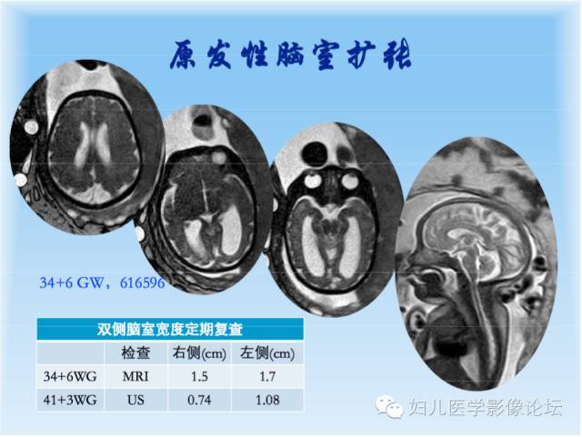 【PPT】胎儿颅脑常见先天异常MRI诊断