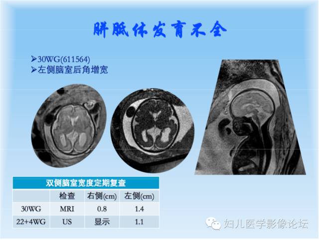 【PPT】胎儿颅脑常见先天异常MRI诊断