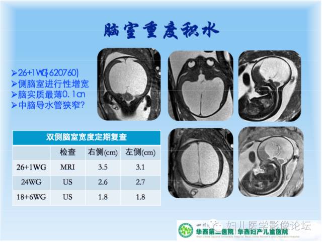 【PPT】胎儿颅脑常见先天异常MRI诊断