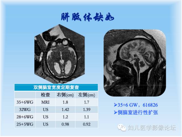 【PPT】胎儿颅脑常见先天异常MRI诊断