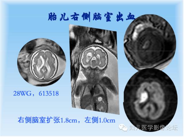 【PPT】胎儿颅脑常见先天异常MRI诊断