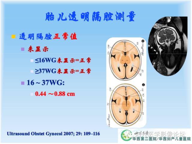 【PPT】胎儿颅脑常见先天异常MRI诊断