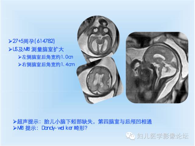 【PPT】胎儿颅脑常见先天异常MRI诊断