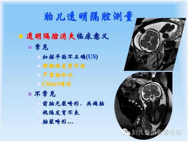 【PPT】胎儿颅脑常见先天异常MRI诊断