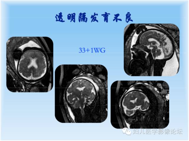 【PPT】胎儿颅脑常见先天异常MRI诊断