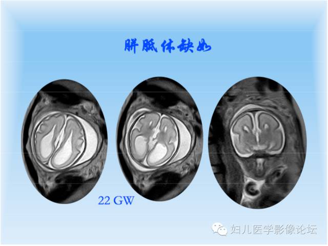 【PPT】胎儿颅脑常见先天异常MRI诊断