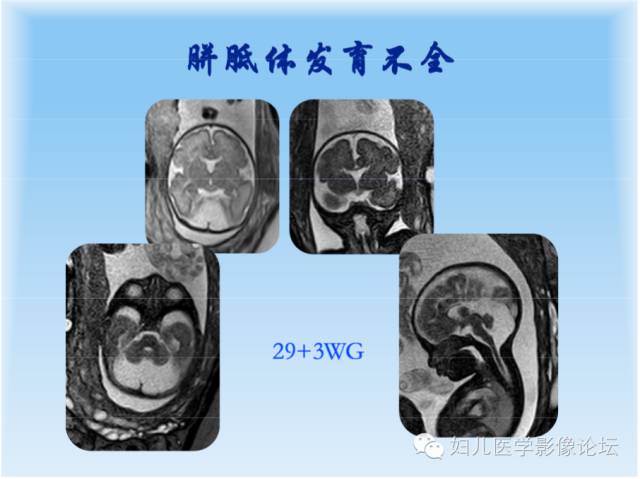 【PPT】胎儿颅脑常见先天异常MRI诊断