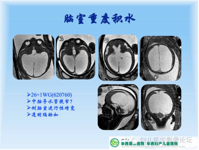 【PPT】胎儿颅脑常见先天异常MRI诊断