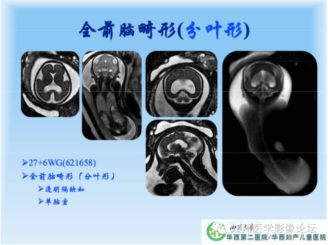 【PPT】胎儿颅脑常见先天异常MRI诊断