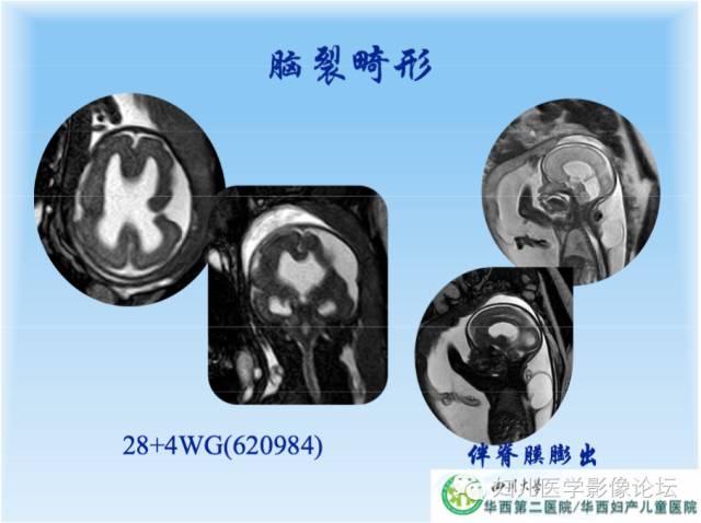 【PPT】胎儿颅脑常见先天异常MRI诊断