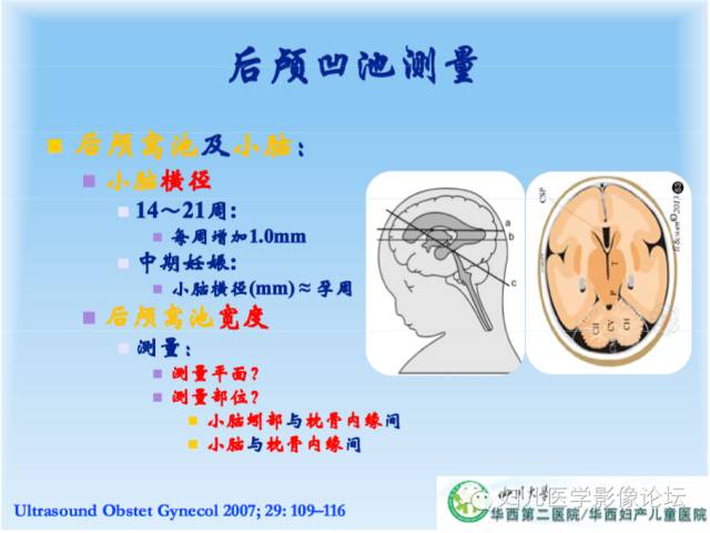 【PPT】胎儿颅脑常见先天异常MRI诊断
