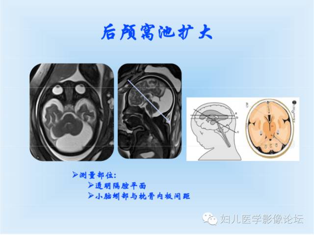 【PPT】胎儿颅脑常见先天异常MRI诊断