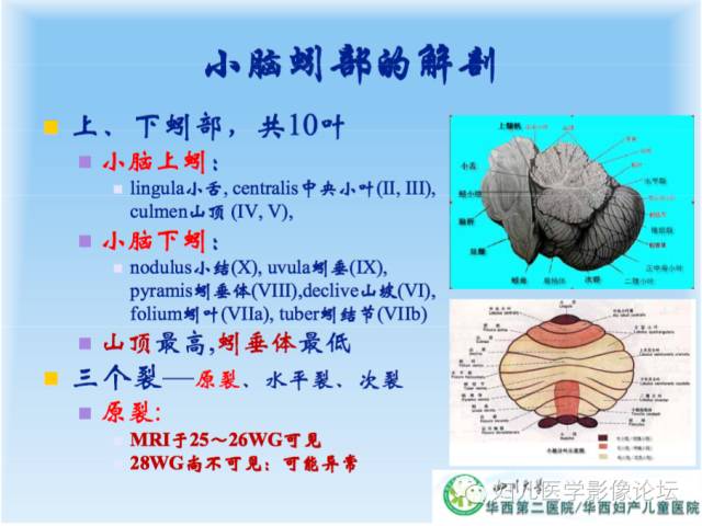 【PPT】胎儿颅脑常见先天异常MRI诊断
