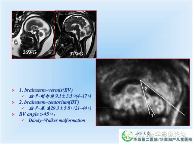 【PPT】胎儿颅脑常见先天异常MRI诊断
