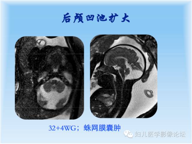 【PPT】胎儿颅脑常见先天异常MRI诊断