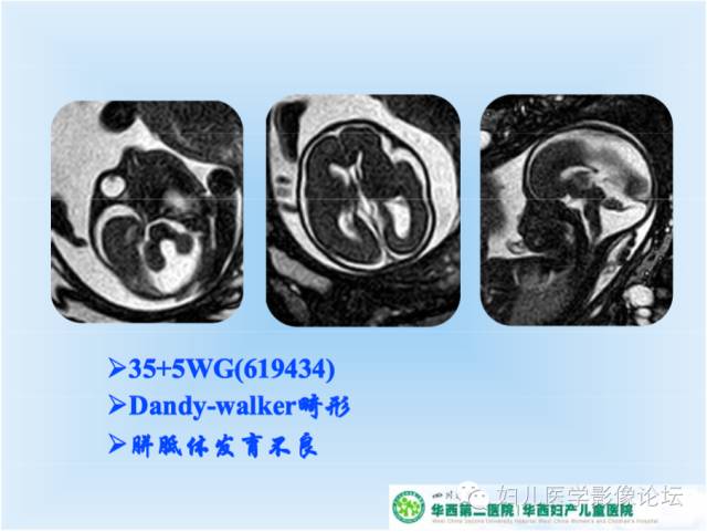 【PPT】胎儿颅脑常见先天异常MRI诊断
