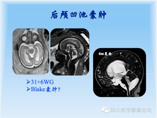 【PPT】胎儿颅脑常见先天异常MRI诊断