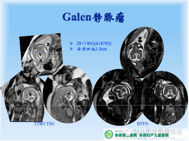 【PPT】胎儿颅脑常见先天异常MRI诊断