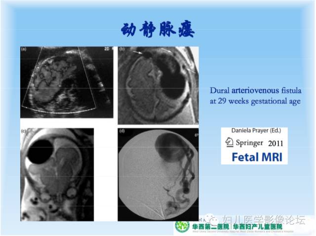 【PPT】胎儿颅脑常见先天异常MRI诊断