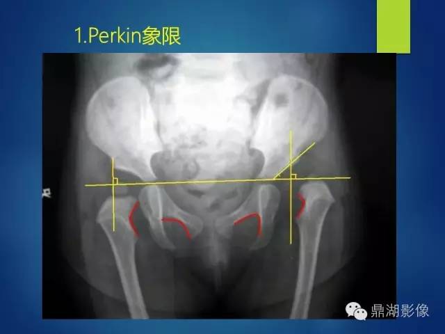 【PPT】骨盆的X线解剖