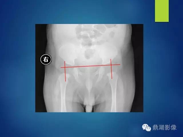 【PPT】骨盆的X线解剖