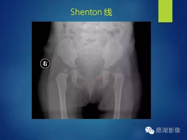 【PPT】骨盆的X线解剖