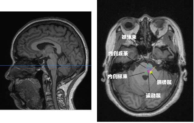 三叉神经解剖——被四大核团掌控的一双胖子手