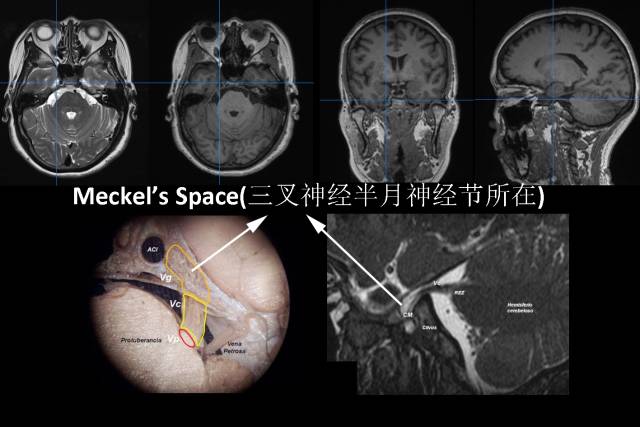 三叉神经解剖——被四大核团掌控的一双胖子手 三叉神经解剖——被四大核团掌控的一双胖子手