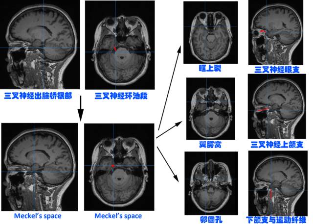 三叉神经解剖——被四大核团掌控的一双胖子手 三叉神经解剖——被四大核团掌控的一双胖子手