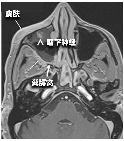 三叉神经解剖——被四大核团掌控的一双胖子手 三叉神经解剖——被四大核团掌控的一双胖子手