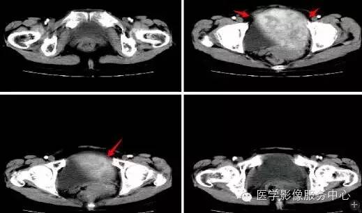 【病例】异位盆腔的副脾 【病例】异位盆腔的副脾