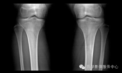 【病例】应力性骨折1例X线CT影像分析 【病例】应力性骨折1例X线CT影像分析