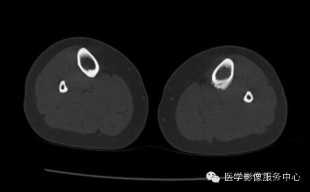 【病例】应力性骨折1例X线CT影像分析 【病例】应力性骨折1例X线CT影像分析