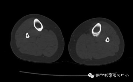 【病例】应力性骨折1例X线CT影像分析 【病例】应力性骨折1例X线CT影像分析