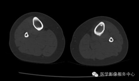 【病例】应力性骨折1例X线CT影像分析 【病例】应力性骨折1例X线CT影像分析