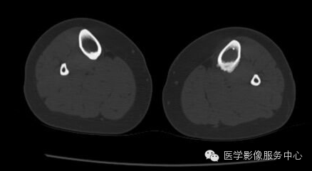 【病例】应力性骨折1例X线CT影像分析 【病例】应力性骨折1例X线CT影像分析