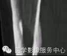 【病例】应力性骨折1例X线CT影像分析 【病例】应力性骨折1例X线CT影像分析