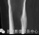 【病例】应力性骨折1例X线CT影像分析 【病例】应力性骨折1例X线CT影像分析