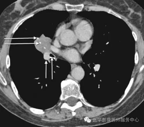 【病例】支气管囊肿1例X线CT影像表现 【病例】支气管囊肿1例X线CT影像表现