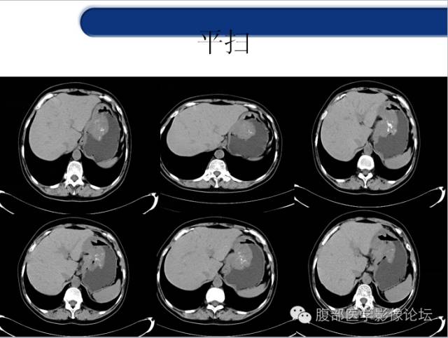 【病例】胃神经内分泌癌+右肾透明细胞癌1例CT