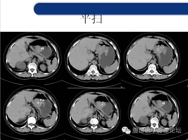 【病例】胃神经内分泌癌+右肾透明细胞癌1例CT