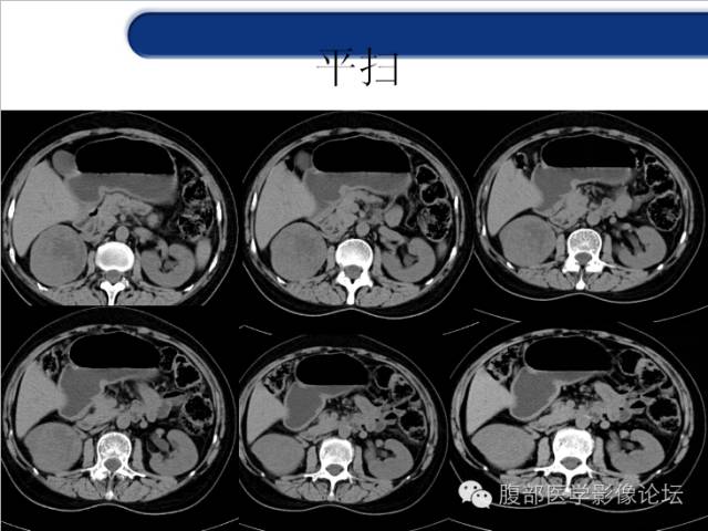 【病例】胃神经内分泌癌+右肾透明细胞癌1例CT