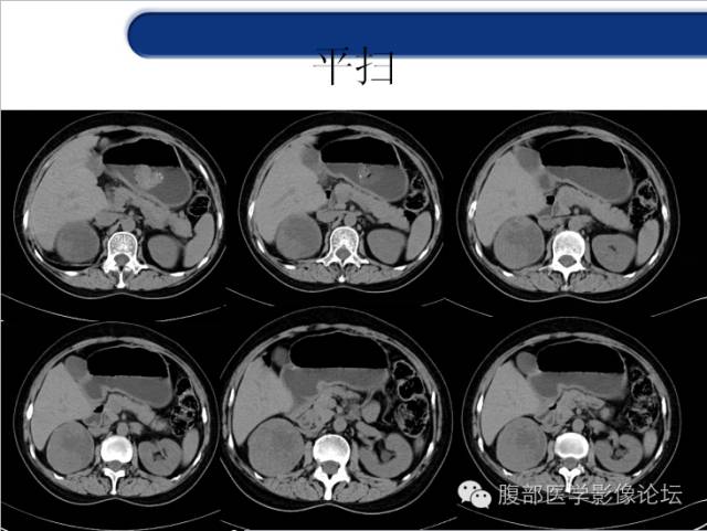 【病例】胃神经内分泌癌+右肾透明细胞癌1例CT