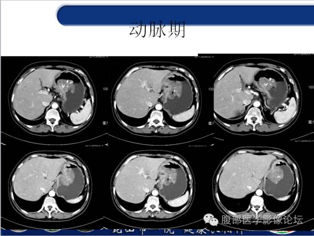 【病例】胃神经内分泌癌+右肾透明细胞癌1例CT
