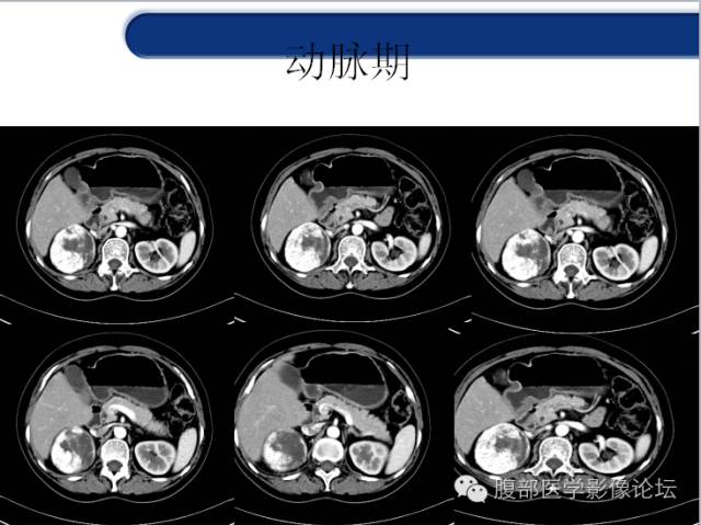 【病例】胃神经内分泌癌+右肾透明细胞癌1例CT