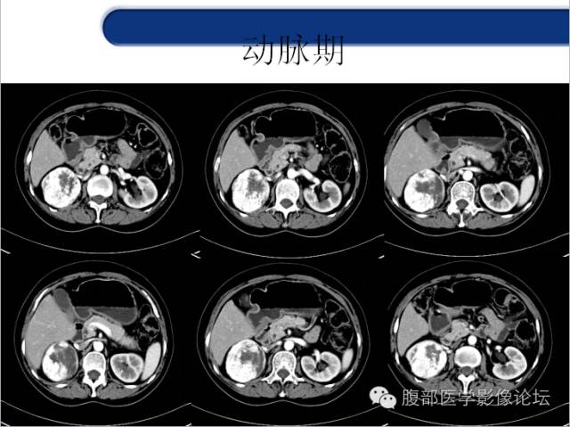 【病例】胃神经内分泌癌+右肾透明细胞癌1例CT