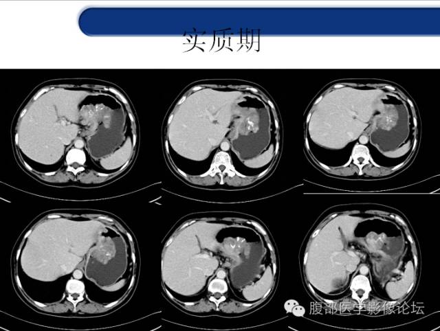【病例】胃神经内分泌癌+右肾透明细胞癌1例CT